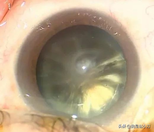 高度近视患者出现白内障的症状,高度近视轻微白内障怎么办