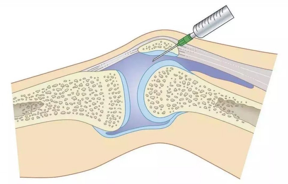 膝盖疼、老寒腿、长骨刺，关节炎了怎么办？45个短问，彻底讲清
