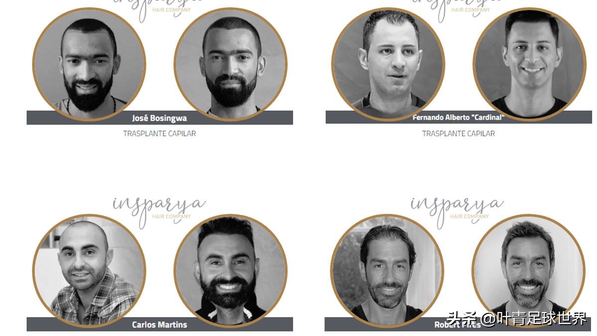 c罗做植发,c罗植发副业史