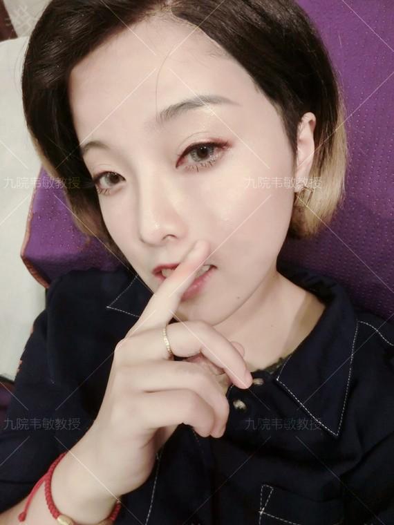 假体隆鼻科普之膨体隆鼻,膨体隆鼻整形效果怎么样