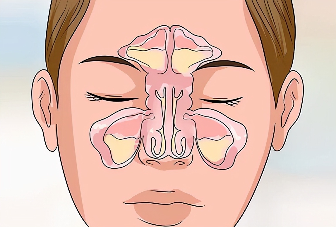 鼻窦炎停了抗生素鼻甲又肿起来了,鼻窦炎为什么很难治愈