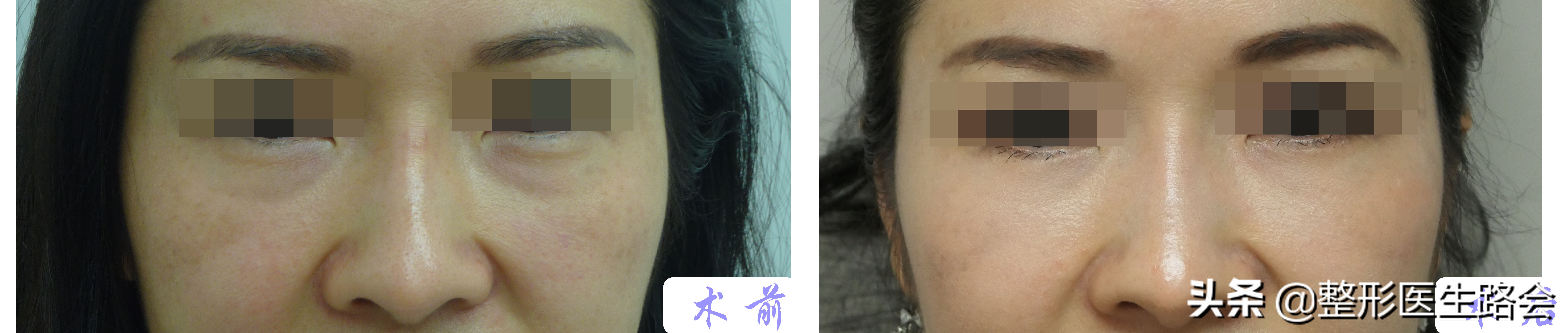 如何区分结构性泪沟,泪沟太明显怎么自己改善