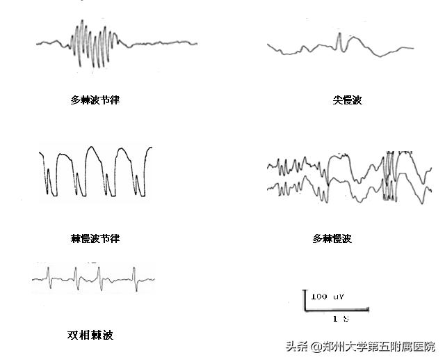 婴儿脑电图检查的危害,什么病要用脑电图检查