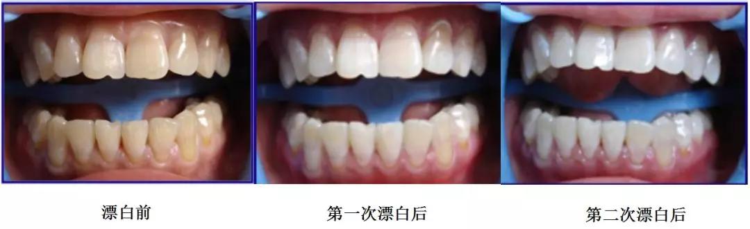 医院冷光美白牙齿大概多少钱,冷光牙齿美白仪哪个牌子好用