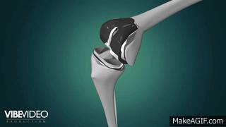 膝盖有骨刺应该注意些什么,膝盖骨刺正确处理办法