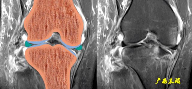 交叉韧带损伤的mr表现,后交叉韧带损伤的诊断实验