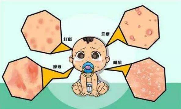 宝宝过敏好了多久可以打疫苗,宝宝过敏快好了可以打疫苗吗