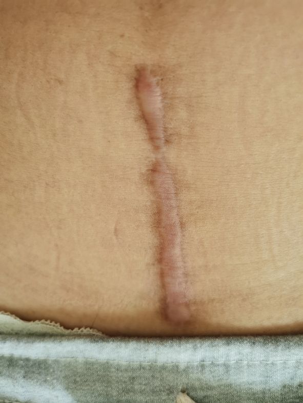 皮肤受伤疤痕修复,疤痕体质受伤后怎么不留疤