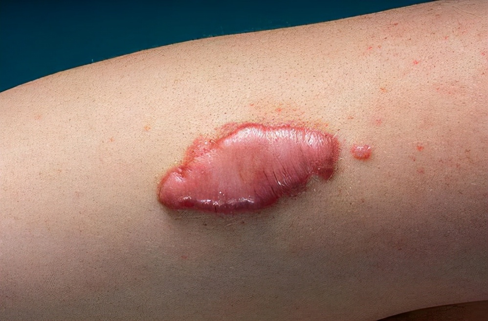 疤痕疙瘩越长越大怎么办,胸前疤痕疙瘩怎么能彻底消除