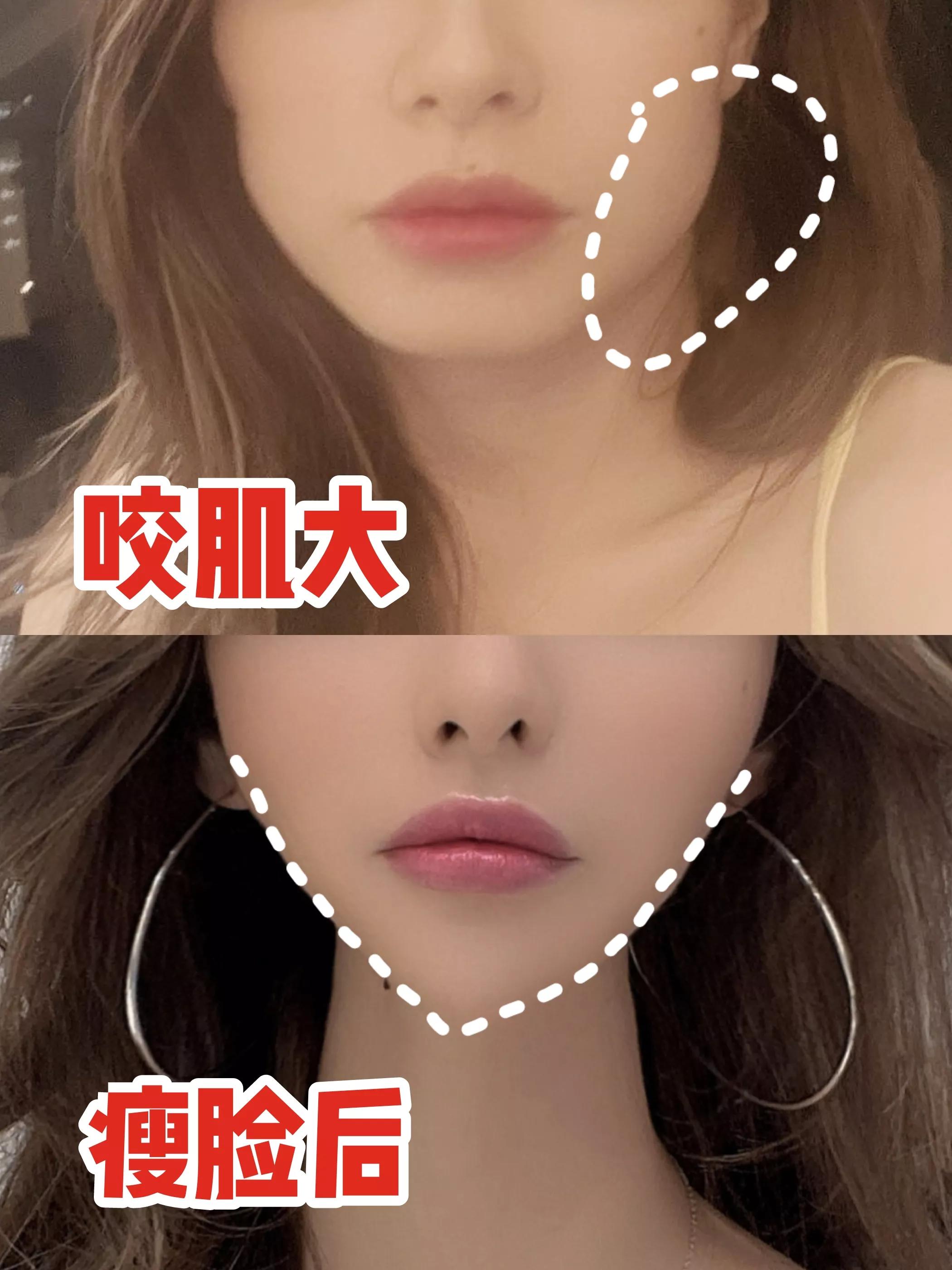 收紧双下巴咬肌面膜,瘦脸面膜双下巴提拉紧致