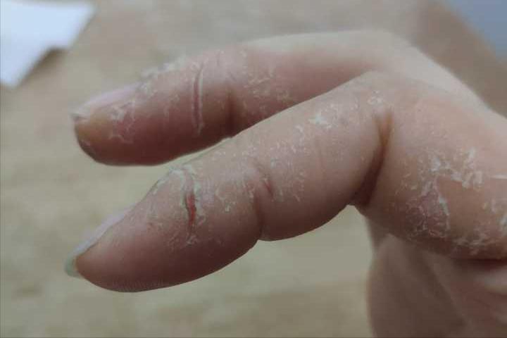 湿疹在中医里面是什么原因引起的,手掌湿疹反复开裂脱皮中医治疗