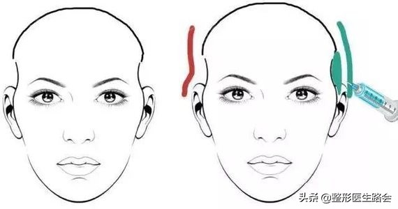 颧骨内推和颧弓有何区别,颧骨内推和颧突有什么区别