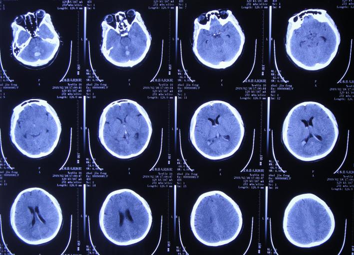 脑出血后脑积水会造成意识不清吗,脑出血后脑积水发高烧危险期多久