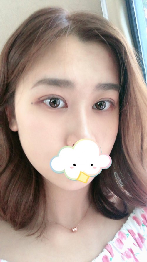 修志夫做双眼皮效果怎么样,修志夫双眼皮修复