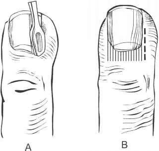 困扰小岳岳的甲沟炎,有没有好的治疗方法?医生给相声粉丝的科普