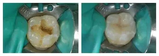 牙齿折断不及时治疗会怎样,牙齿折断了只剩根部