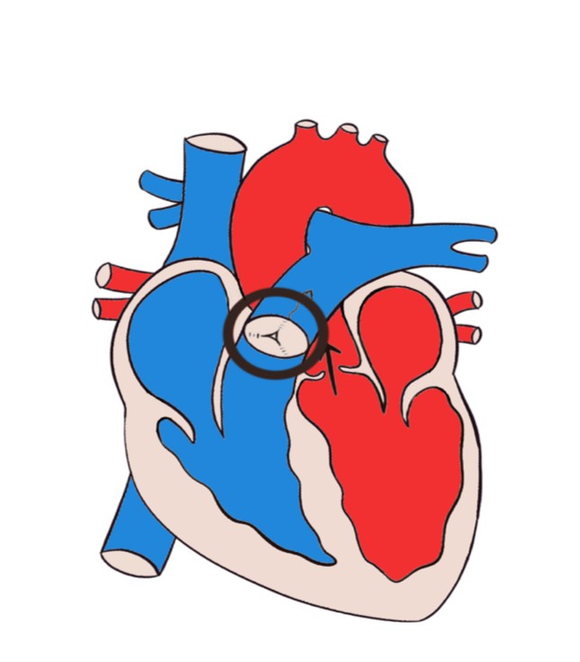 先天性肺动脉瓣狭窄还能当兵吗,关于先天性心脏病的热点问答