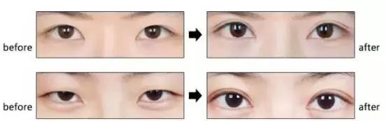 想做双眼皮是不是得检查下视力,想做双眼皮攻略