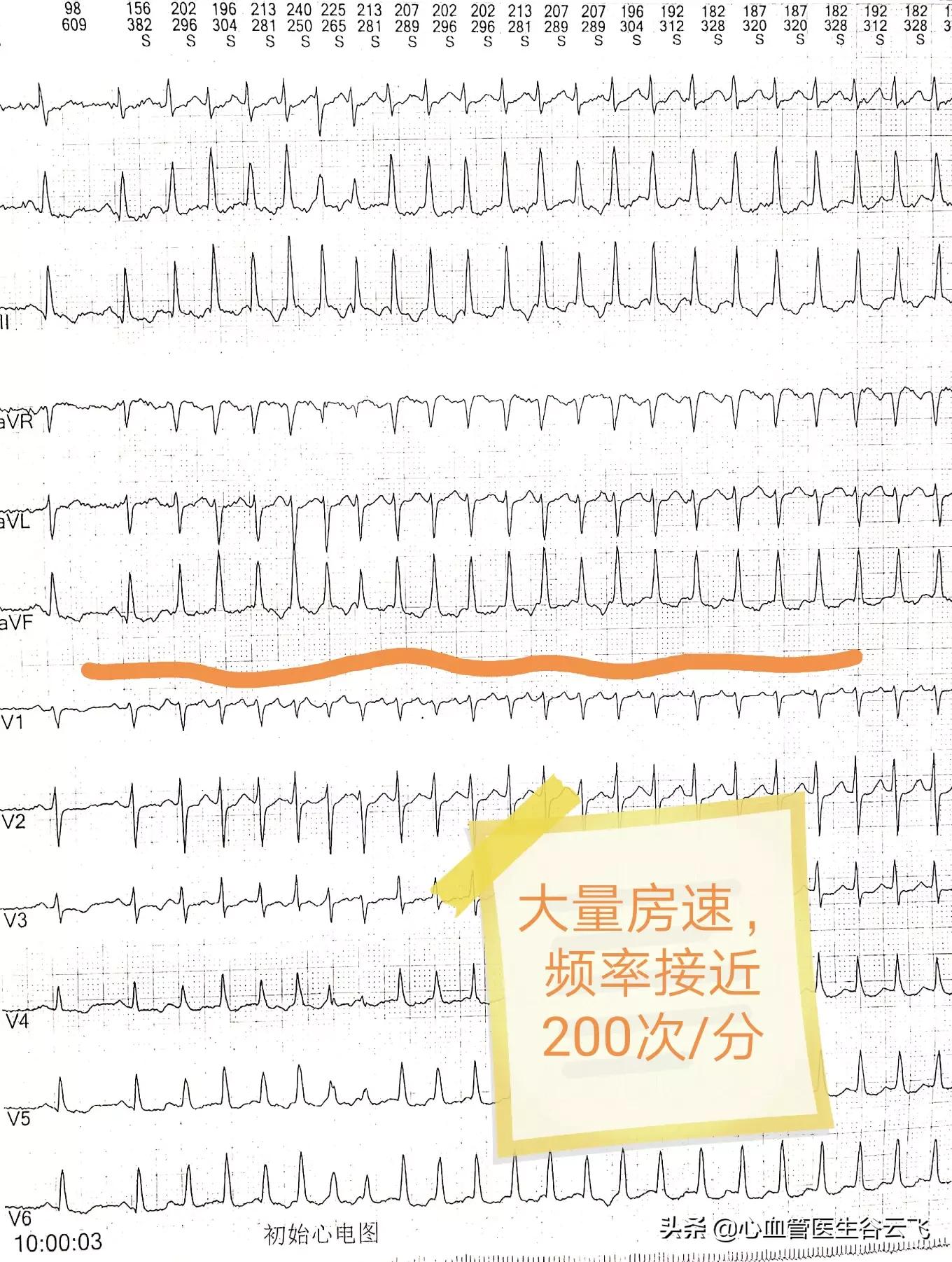 心律失常频发房性期前收缩,心律失常门诊故事
