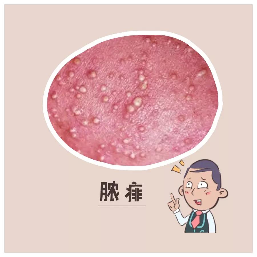 热天痱子怎么治,热天有痱子用什么最好