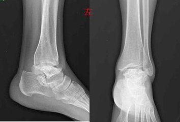 痛风病人饮食不正确,痛风患者营养失调的护理措施