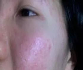 改善暗沉闭口粉刺敏感肌的水乳,如何拯救烂脸痘痘肌