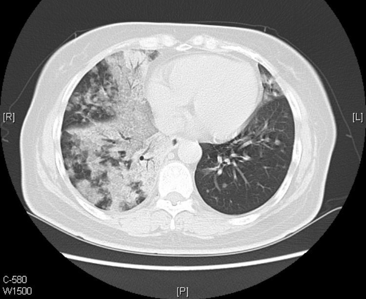 黏液腺癌基本不转移不复发,肺粘液腺癌转移了还能治好吗