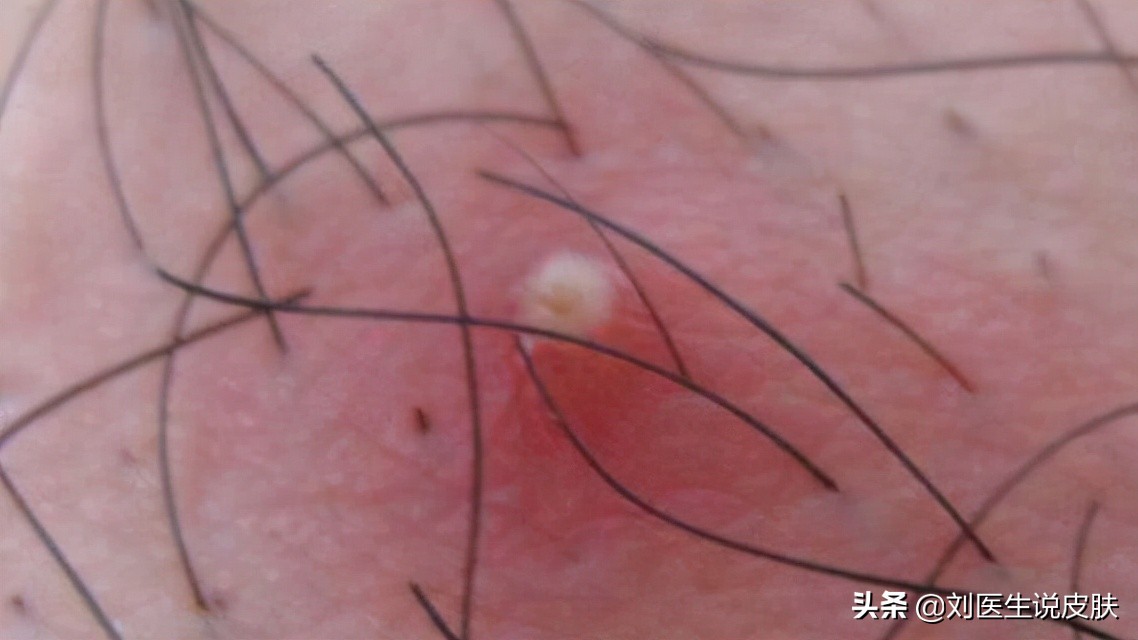 前胸后背的痘痘是痤疮还是毛囊炎,前胸后背都是痘痘毛囊炎怎么处理