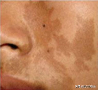 咖啡斑短时间内增大,宝宝身上的牛奶咖啡斑增大了