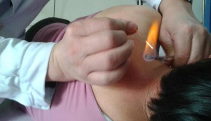 火疗引火烧身,引火归元针治疗三种病