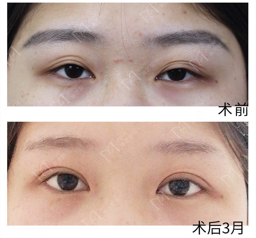 三眼皮显老气吗,三眼皮真的很好看吗