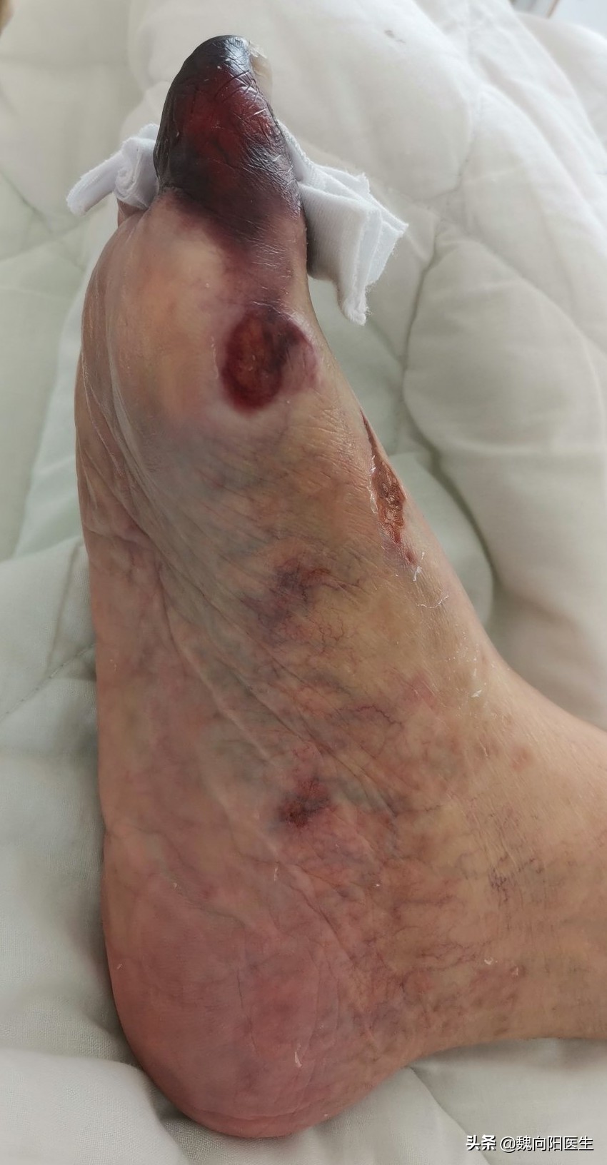 脚趾是平的是糖尿病足么,糖尿病足脚趾甲会什么样