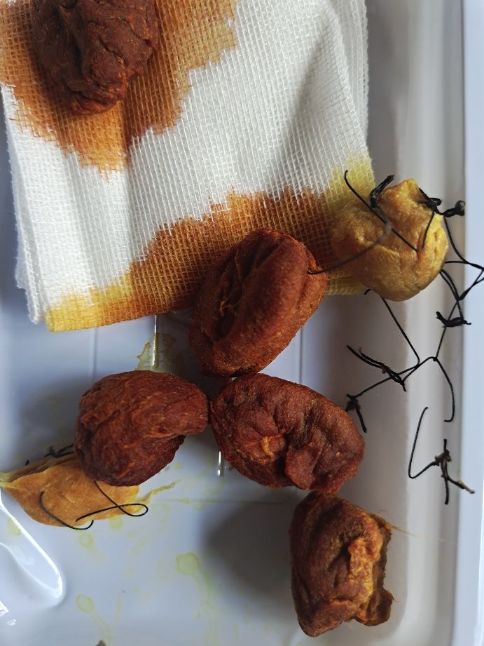 手术后伤口愈合线不拆,手术刀口开线不愈合如何处理