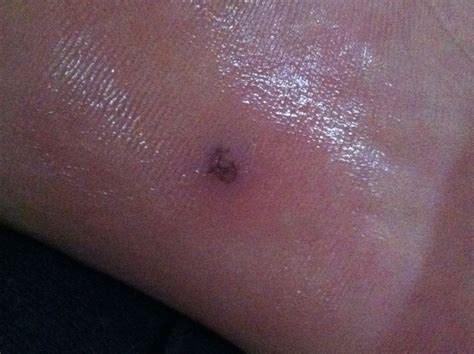 竹签刺破了手指要不要打破伤风针,竹签刺到会得破伤风吗