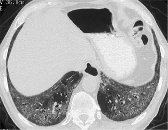 间质性肺疾病看病经验分享,分享肺腺癌临床实验的例子