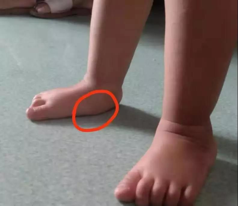 西安治疗扁平足最好的医院,扁平足拇指外翻的治疗方法