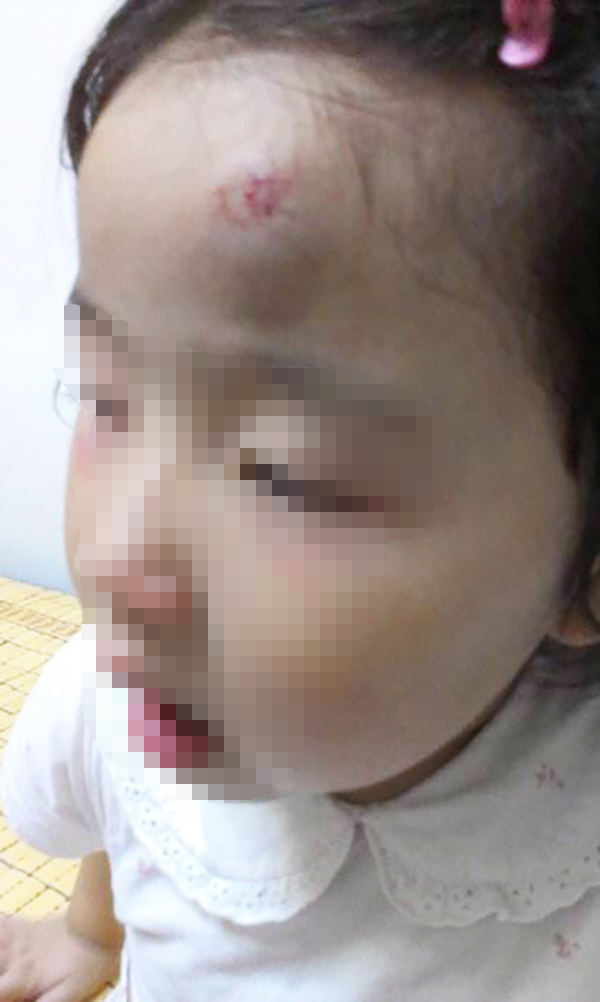 女儿摔倒头磕了一个大包,小朋友摔倒额头磕个大包要紧嘛