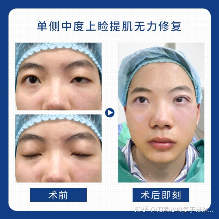 双眼皮割毁了可以修复吗,切开双眼皮失败可以用埋线修复吗