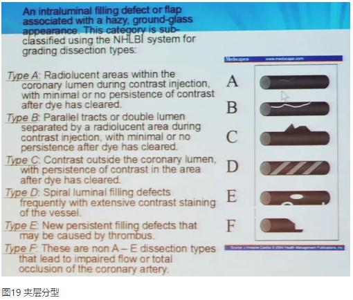 清晰完整揭秘冠脉造影全部过程,冠脉造影教学视频