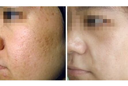 脸上痘印怎么最快淡化医美,夏季美白消痘印护脸霜