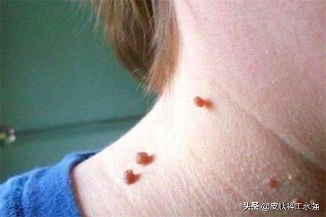 脖子上的小肉粒丝状疣怎么传染,脖子上长的小疙瘩是病毒性扁平疣