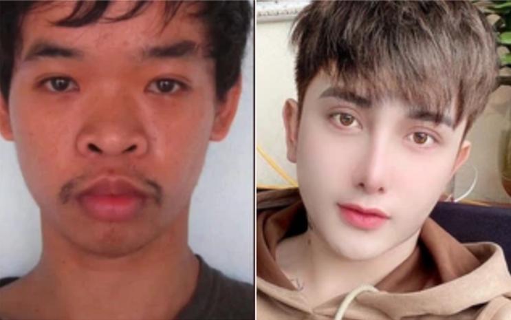 越南丑男整容变帅,越南小伙儿整容成功