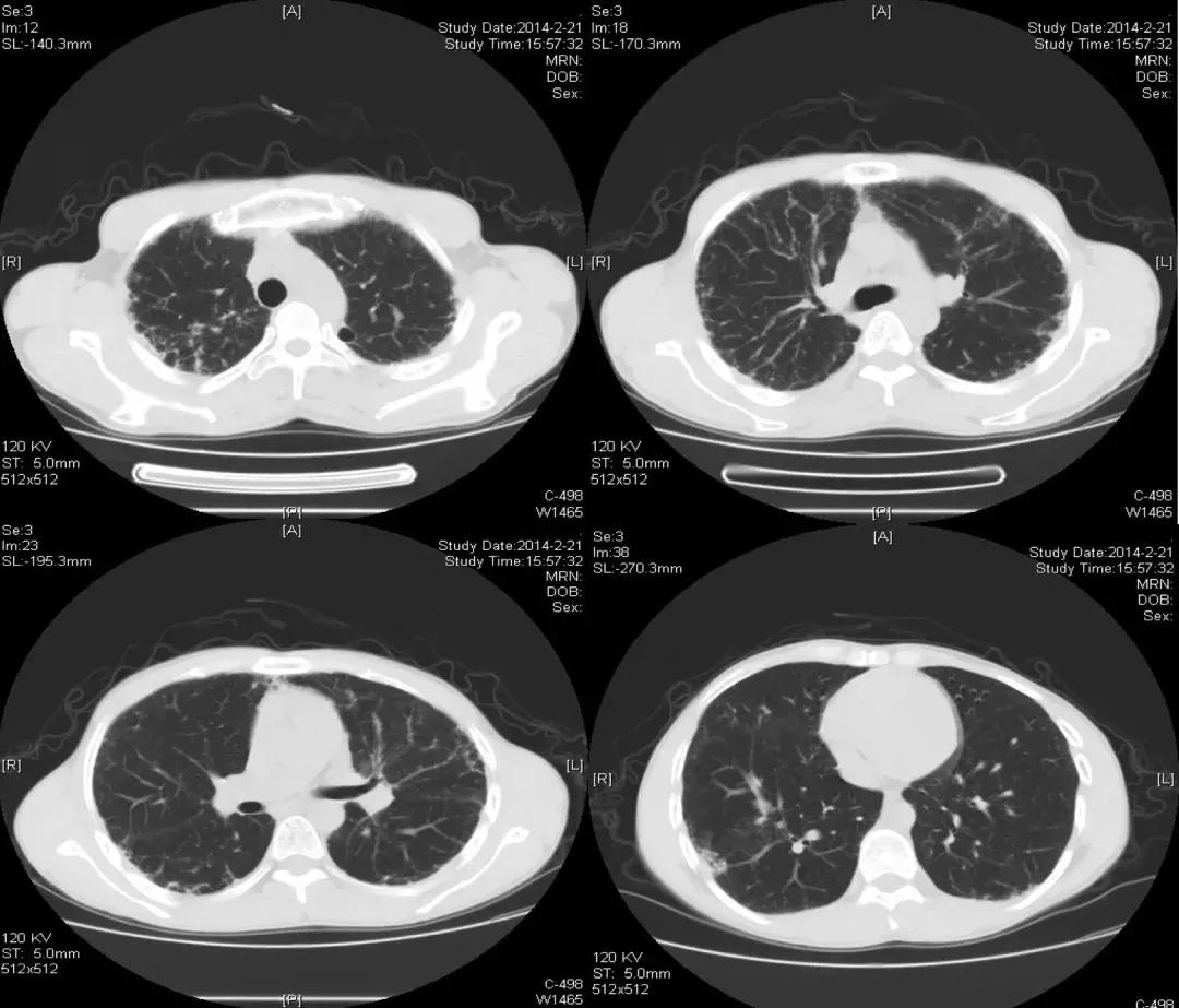 肺纤维化病例,肺纤维化手指甲发紫还能活多久