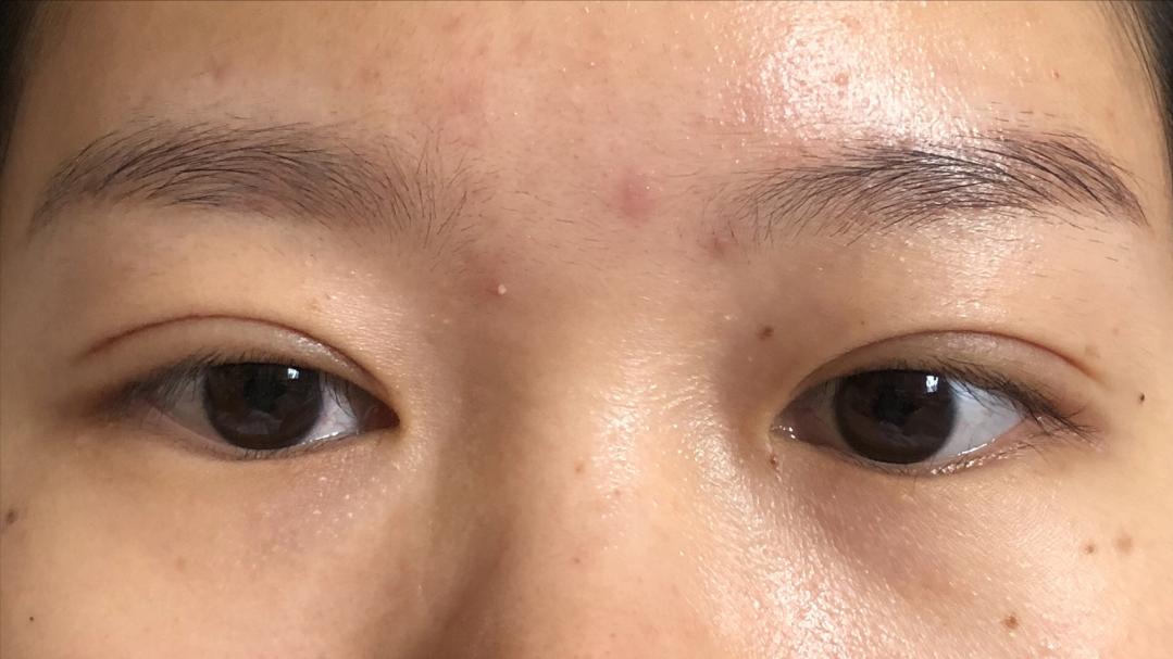 做个双眼皮手术30000块钱贵吗,做双眼皮花了15000贵了吗