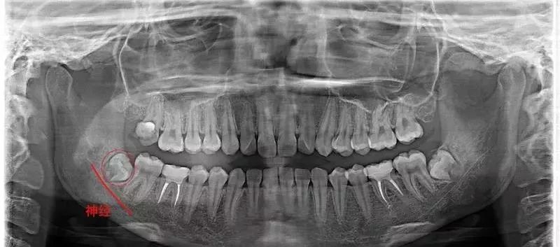 为什么拔智齿那么疼,为什么拔智齿会痛这么久