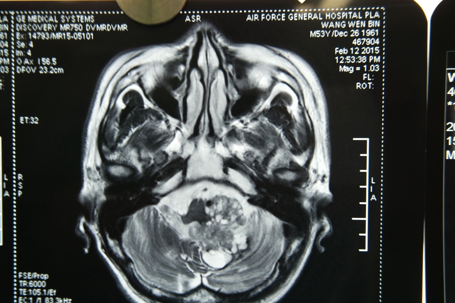 颅内肿瘤微创全过程,第四脑室肿瘤能做微创手术吗