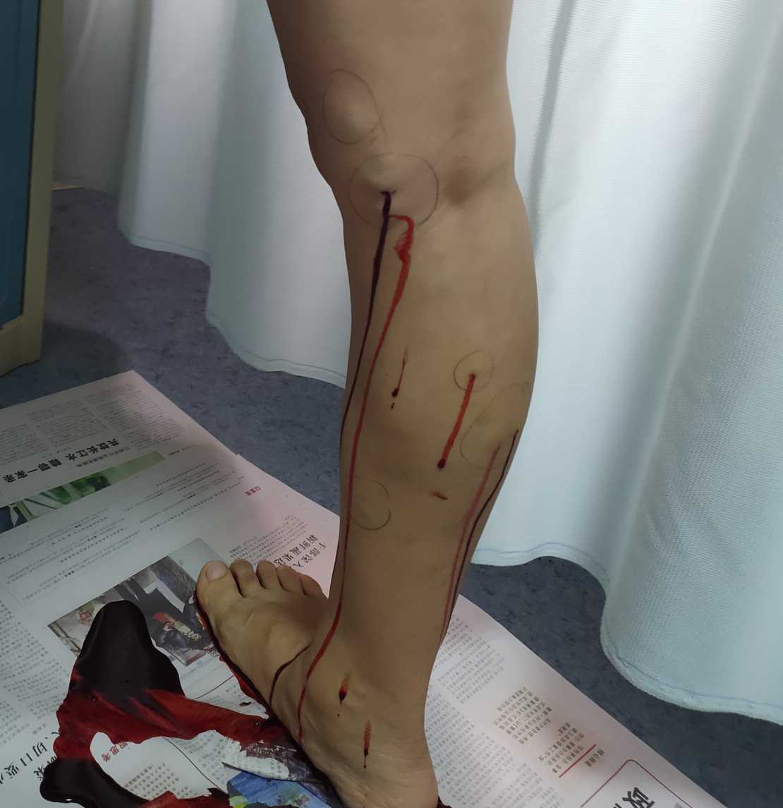 缓解静脉曲张的运动方法3种,缓解腿部静脉曲张最好的药