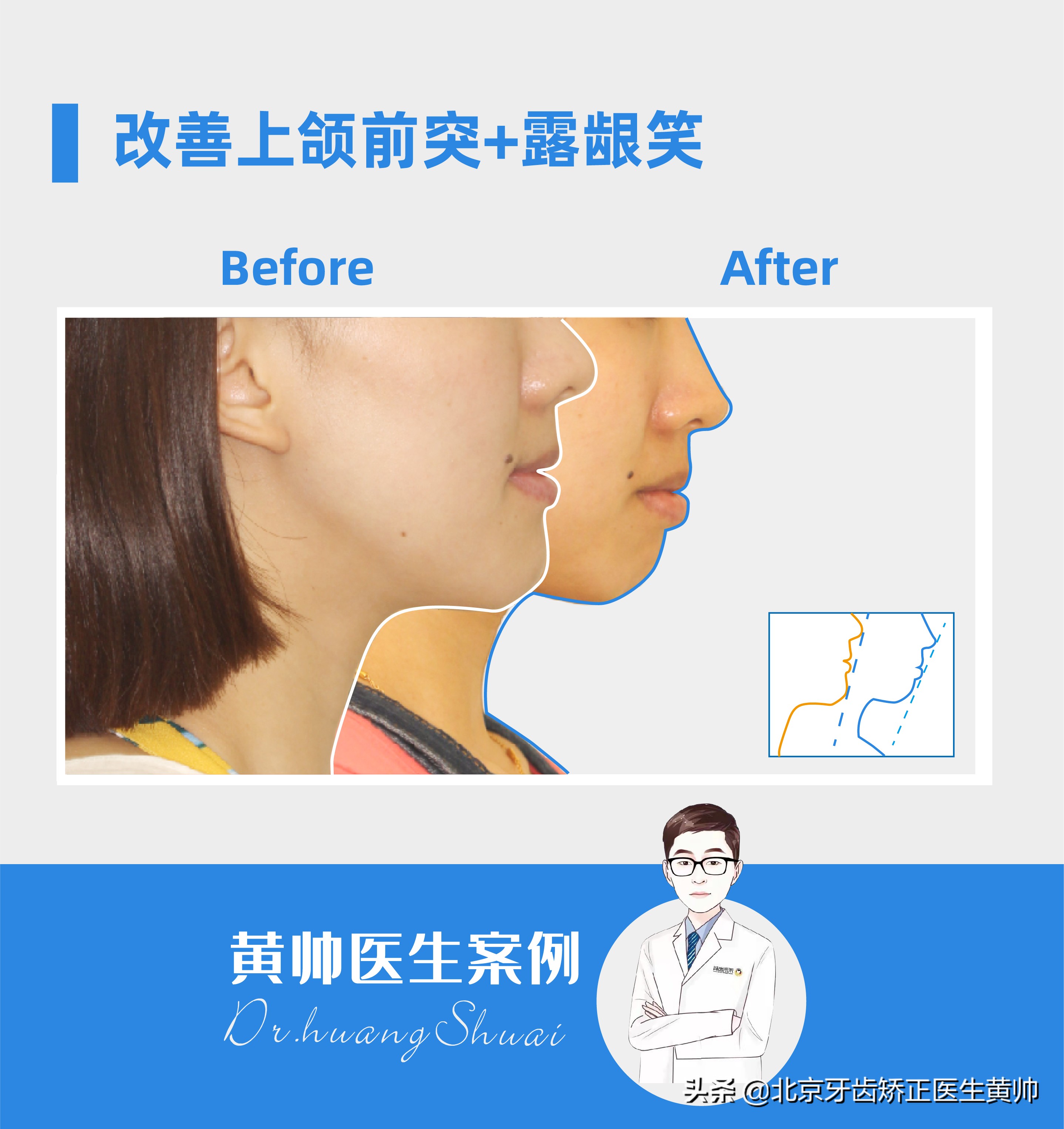 橡胶牙套矫正后脸型变化,戴过牙套的脸恢复了吗