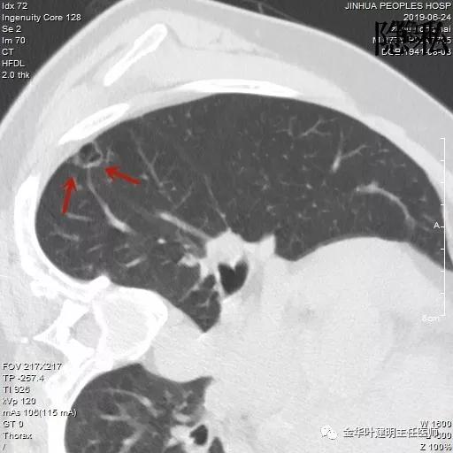 警惕-会是简单的肺大泡吗？