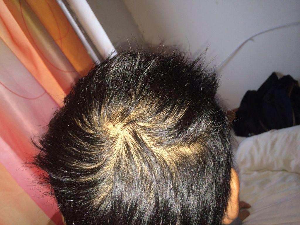 头皮总是痒是有螨虫吗,头皮上有螨虫一次可以清除干净吗